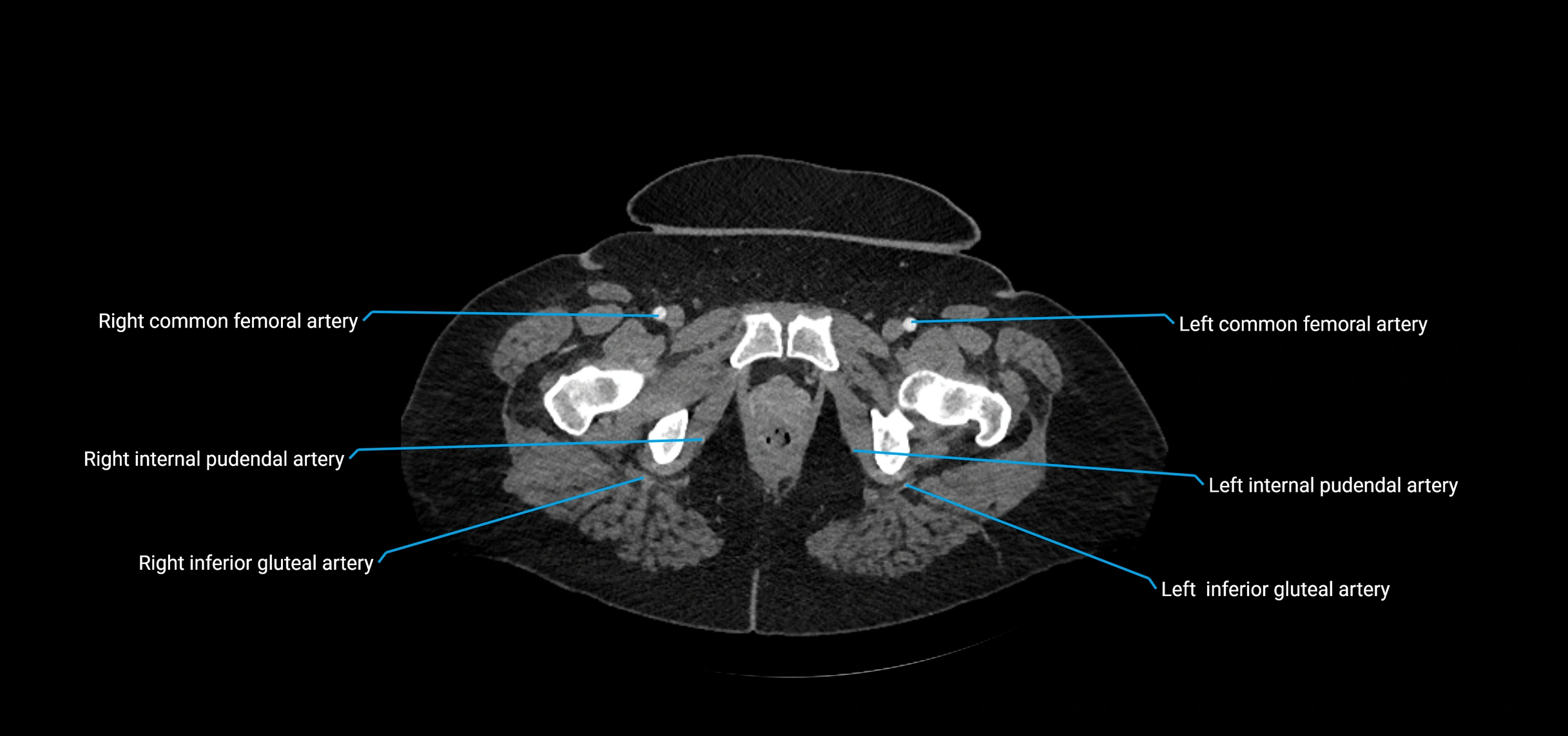 CTA abdomen axial cross sectional anatomy labelled image_262 (2).webp